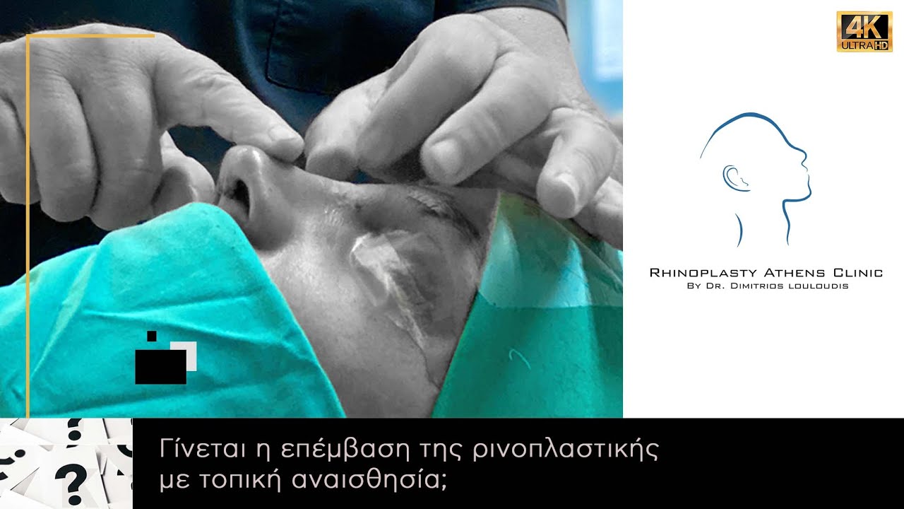 Γίνεται η επέμβαση της ρινοπλαστικής με τοπική αναισθησία;
