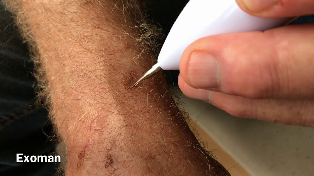 How to remove sun spots, age spots and moles DIY