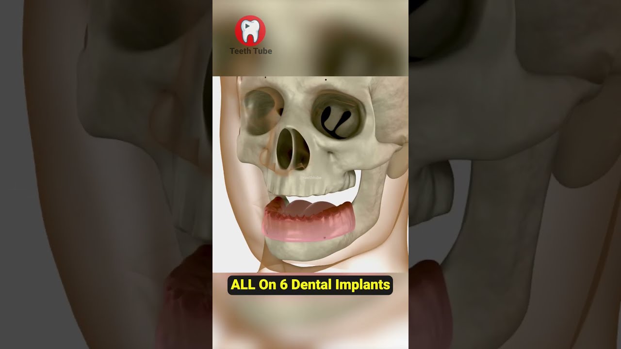 All On 6 Dental Implants #shorts
