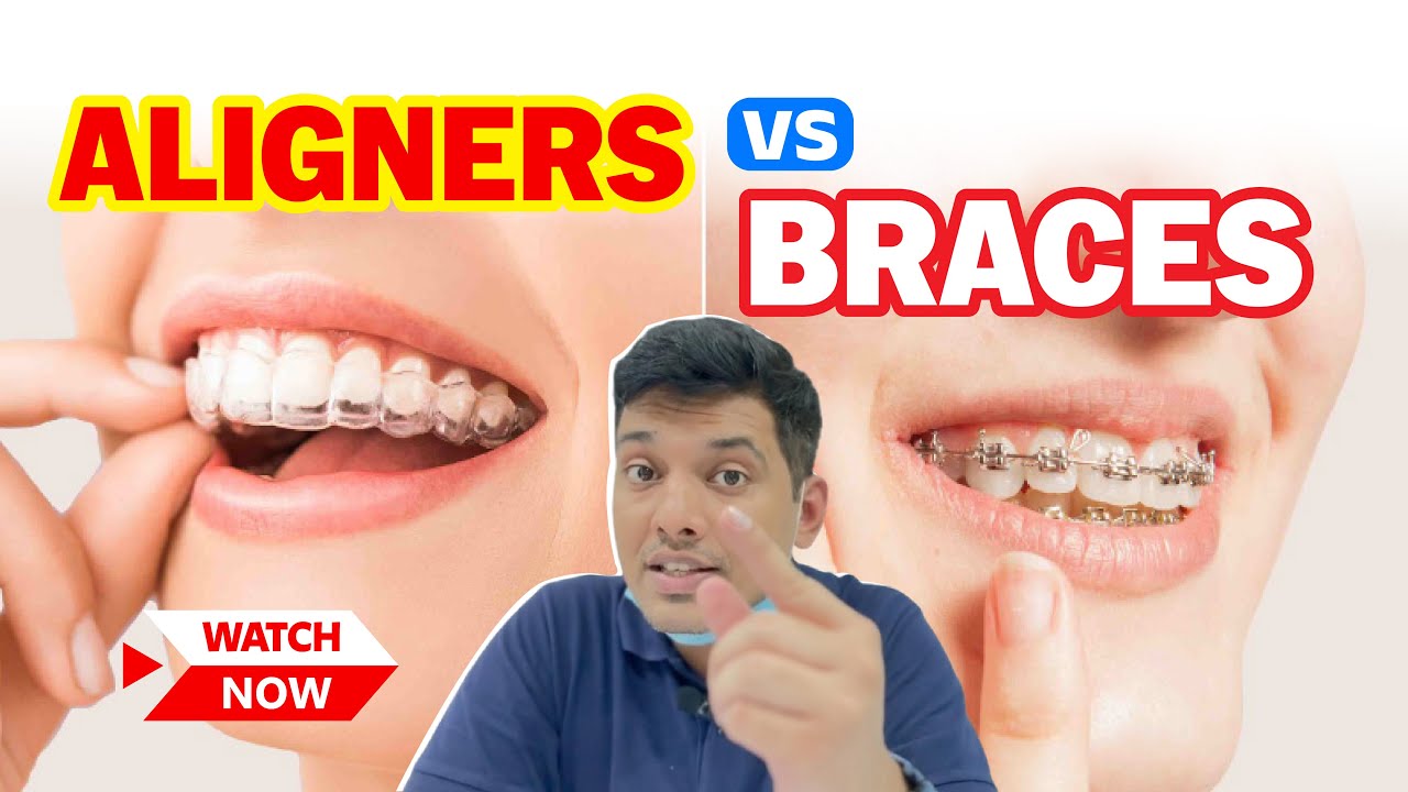Aligners Vs Braces : Which Is Better For Teeth Alignment? Orthodontist In Gr Noida - Dr Ishan Singh