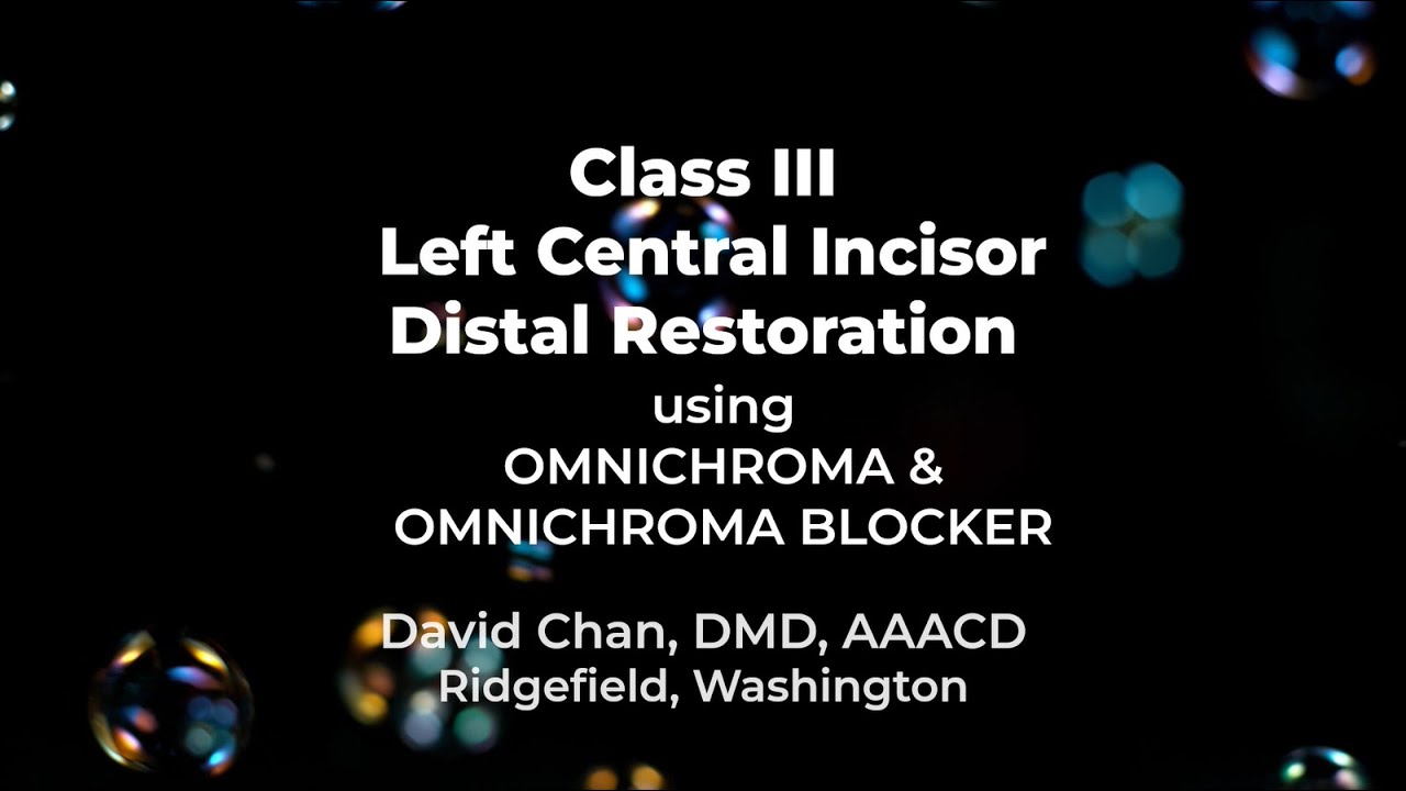 Class III Left Central Incisor Distal Restoration using OMNICHROMA & OMNICHROMA BLOCKER