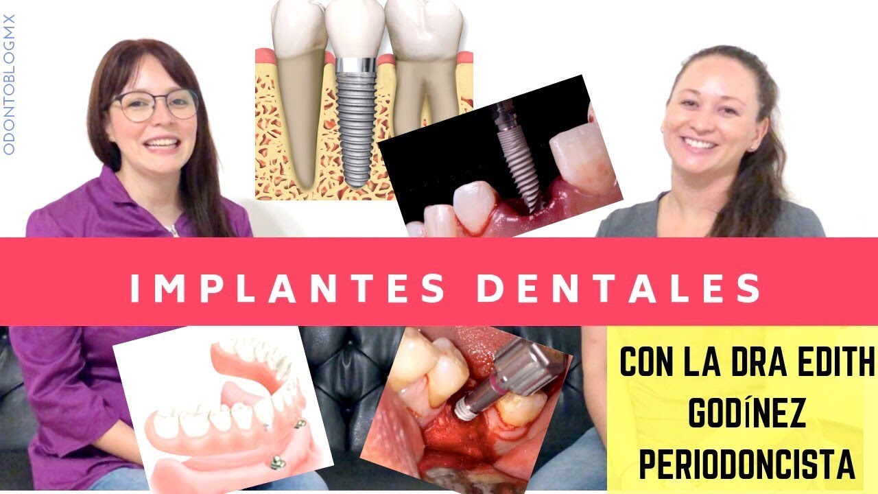TODO SOBRE Implantes Dentales 🔩 🦷 con Dra Edith Godínez Padilla