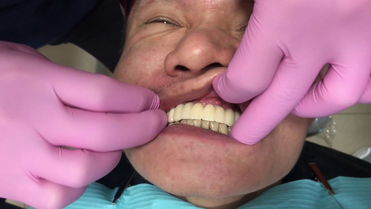 All on 4 alternative   The all on 8 dental implant solution 1 date 2 3 2018