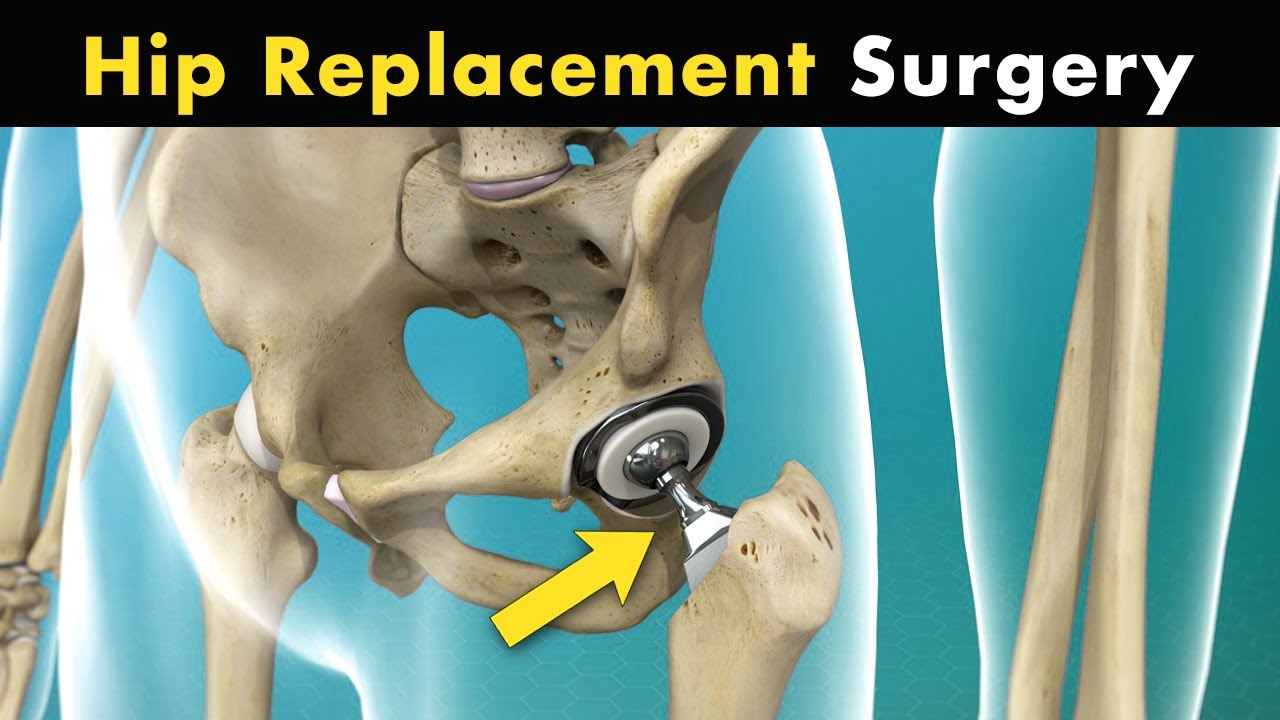 How Hip Replacement Surgery Is Performed? | Hip Arthroplasty (3D Animation)