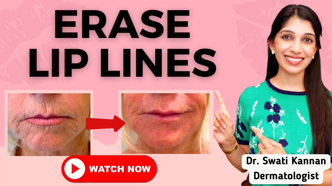 Erase Lip Lines: Top Skincare and Cosmetic Solutions from a Dermatologist