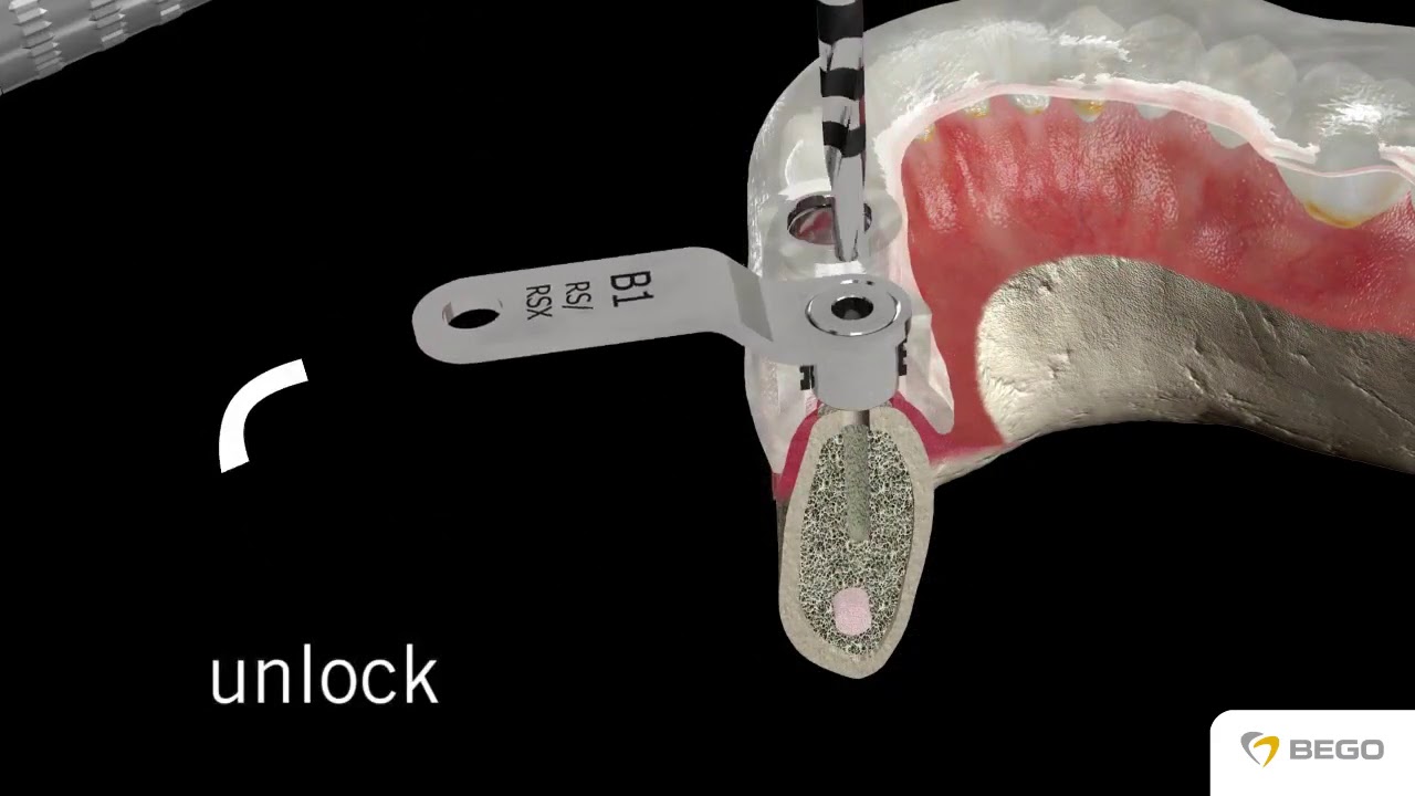 Guided surgery with BEGO Guide RS RSX Line