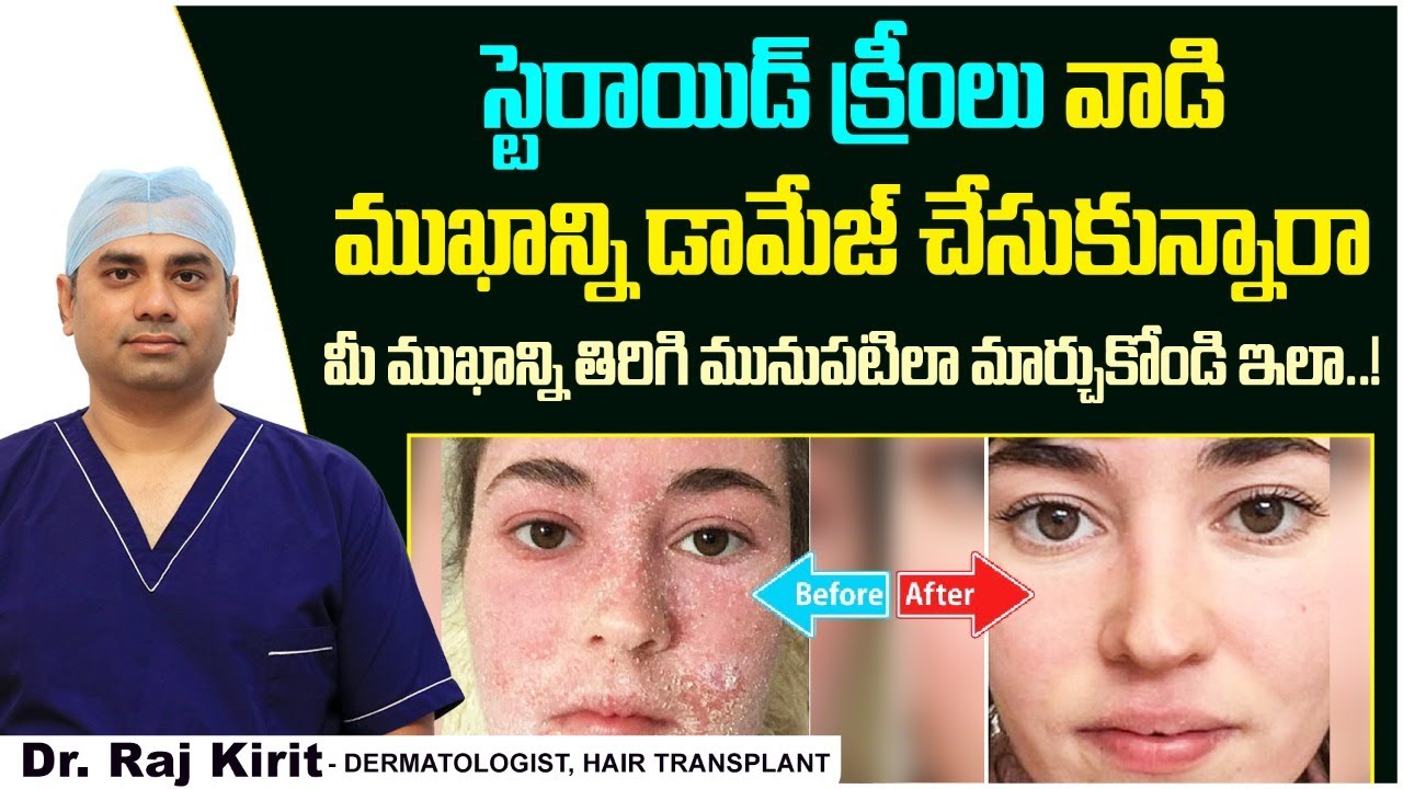 డామేజ్ అయిన ముఖానికి బెస్ట్ క్రీం | Steroid Cream Side Effects Treatment in Telugu | Celestee Clinic