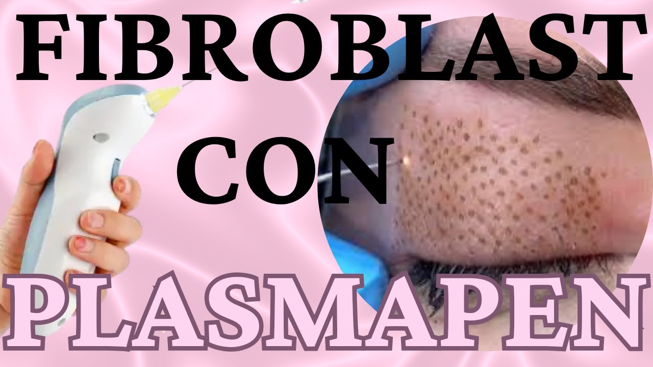 “Fibroblast con Plasma Pen: Lifting Facial, Estrías y Acrocordones (Clase Completa)”