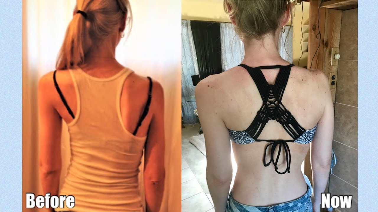 How My Scoliosis Treatment Has Changed My Life | Updated Treatment Results | Rehab Based Treatment