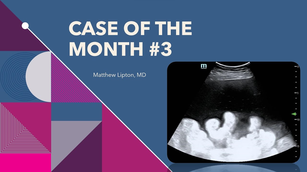 Case of the month #3 (how you use POCUS to make your paracentesis even safer!)