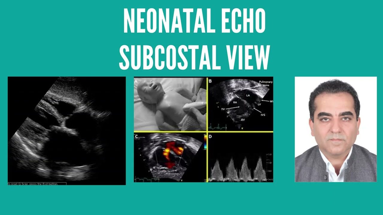 Subcostal view l Neonatal echo 