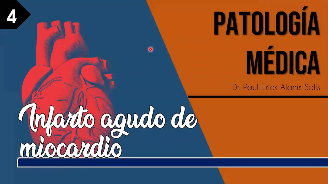 Infarto Agudo de Miocardio - Diagnóstico y tratamiento