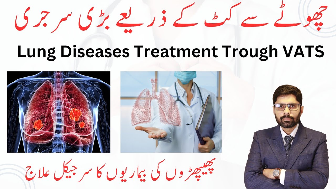 Lung Diseases Treatment Trough VATS | Dr. Ahmad Ali Thoracic Surgeon | Urdu/Hindi