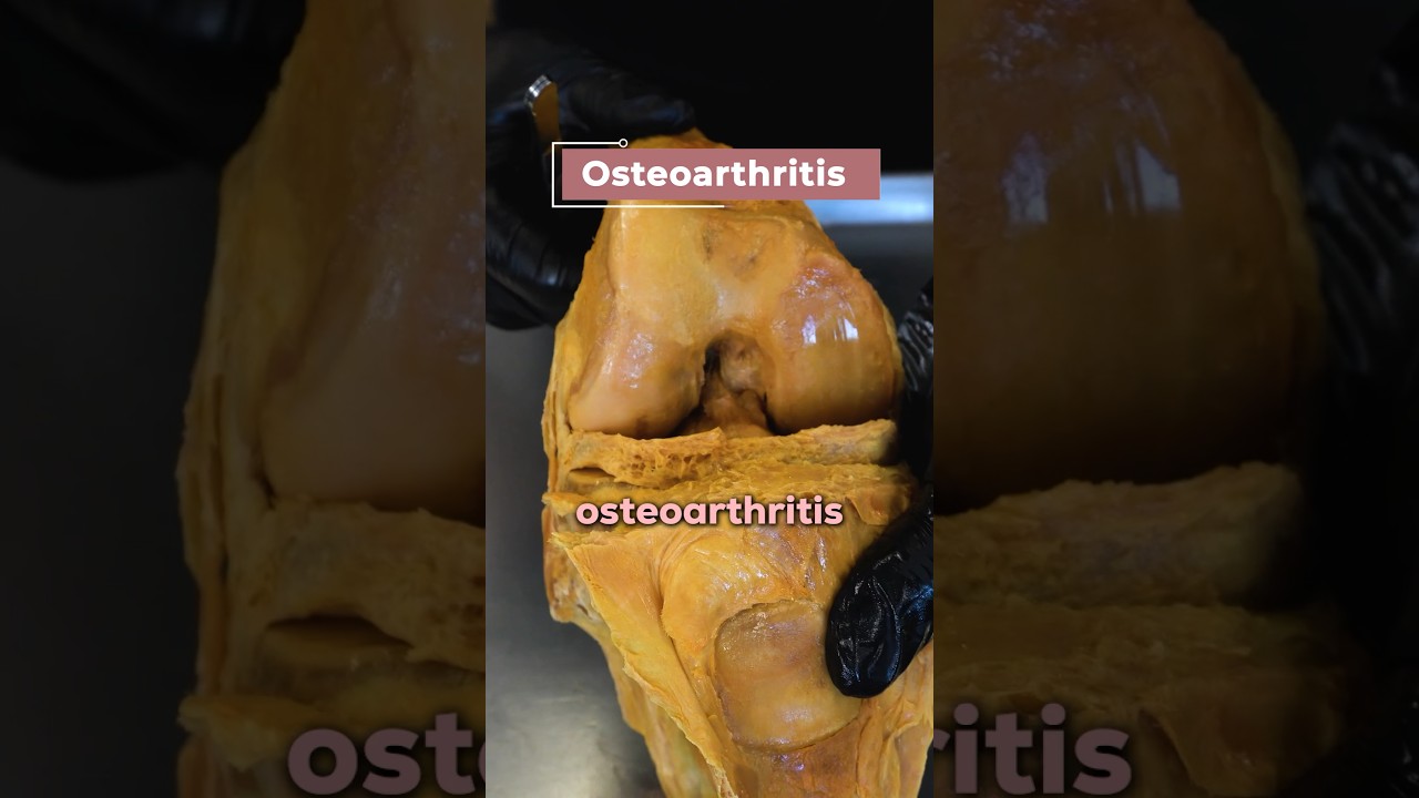 Look At This Degenerated Knee! #arthritis