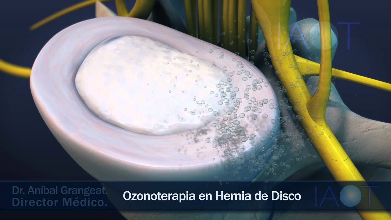 IAOT 3D Ozonoterapia en Hernia de Disco