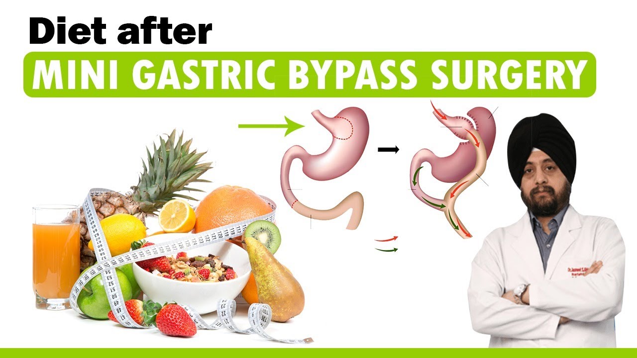Diet after Mini Gastric Bypass Surgery | Eating after MGB Operation | Food after Bariatric Surgery