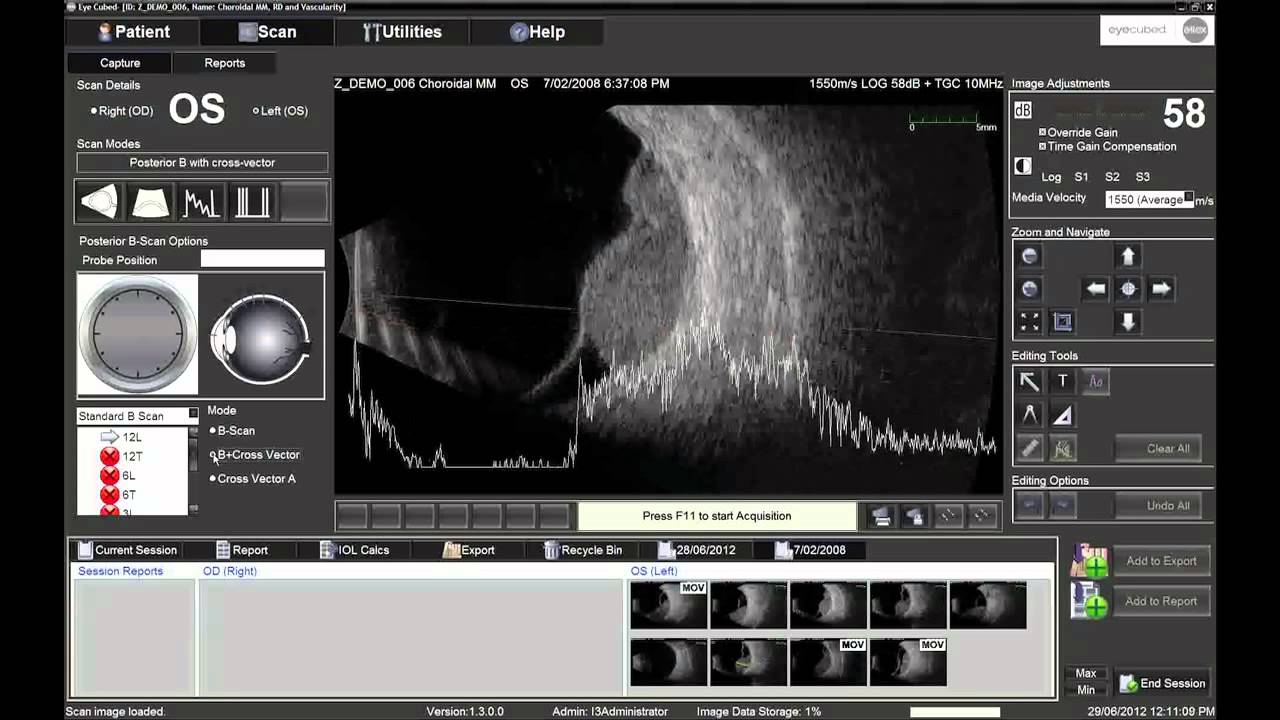 Performing 10MHz B-Scan with the Ellex Eye Cubed