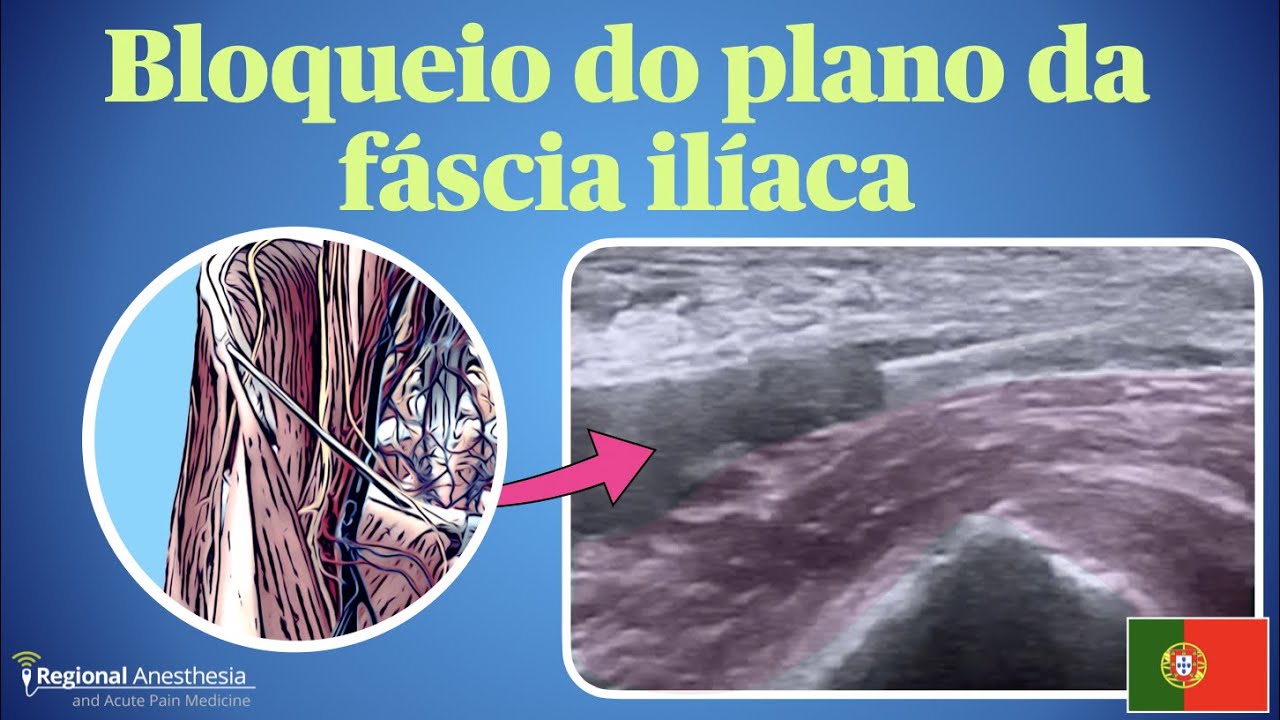 Bloqueio do Plano da F&aacute;scia Il&iacute;aca Suprainguinal (Suprainguinal Fascia iliaca Plane Block)