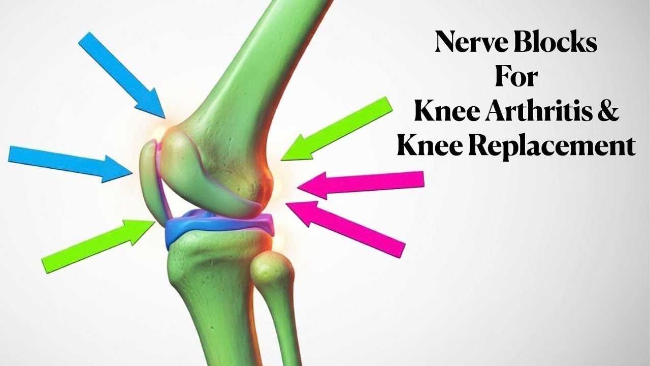 Nerve Blocks for KNEE ARTHRITIS & KNEE REPLACEMENT