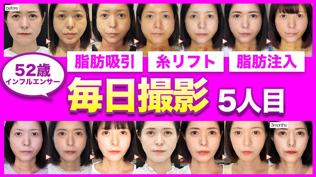 【再整形】ダウンタイム3ヶ月全てレポート【脂肪吸引/糸リフト/エンブレイスRF】