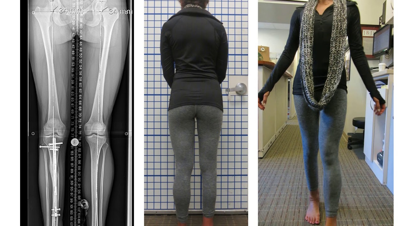 When to Amputate and When to Reconstruct