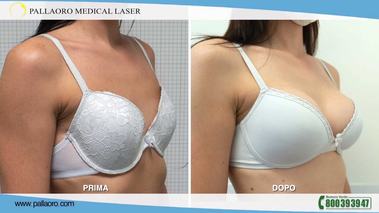 Mastoplastica additiva: Valentina ha un seno nuovo