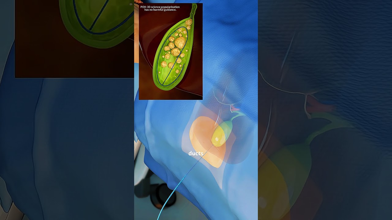 How Gallstones Are Formed & Removed Without Surgery | Cholangioscopy + Lithotripsy Explained&rdquo; #drone