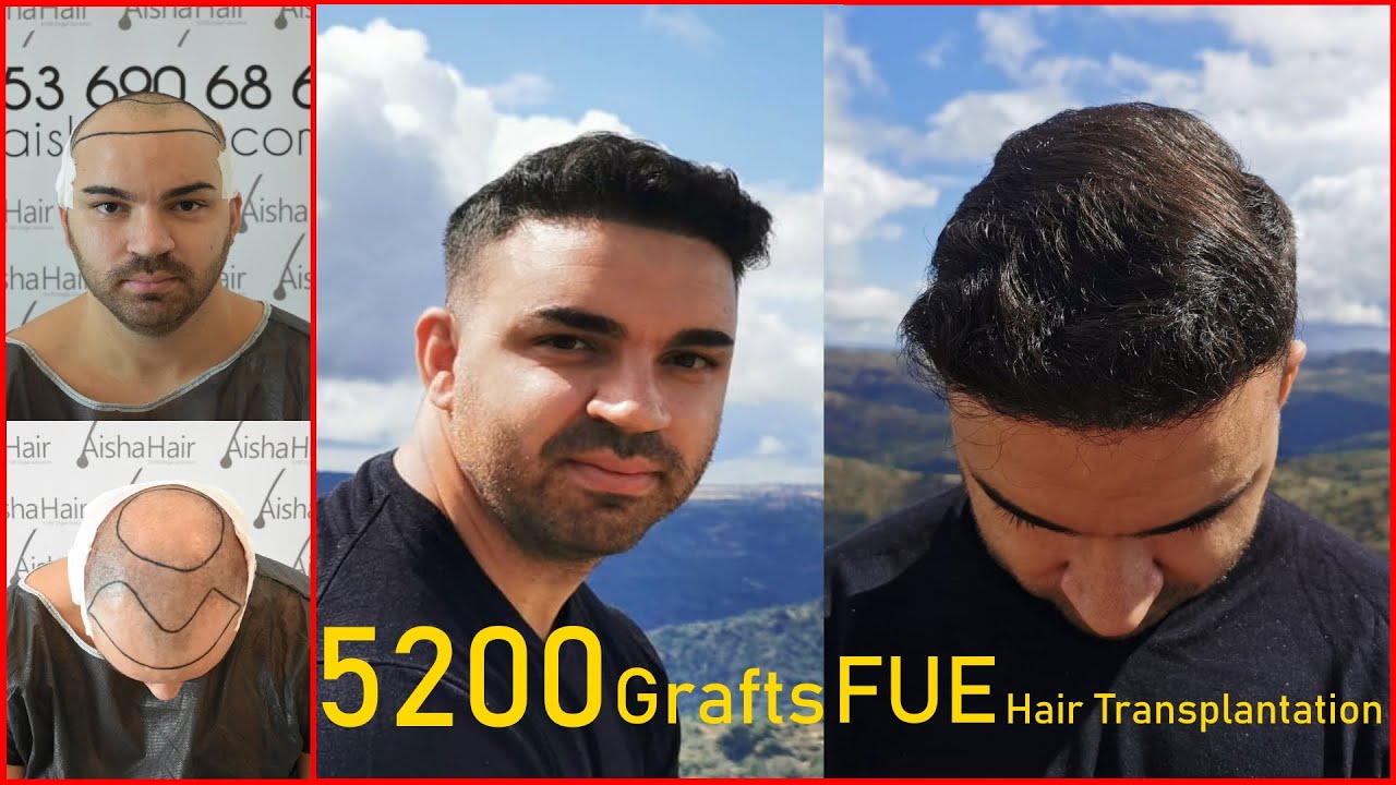 5200 Grafts Norwood 5 Aisha Hair Transplant / 5200 Foliculos Norwood 5 Injerto Capilar Aisha Hair