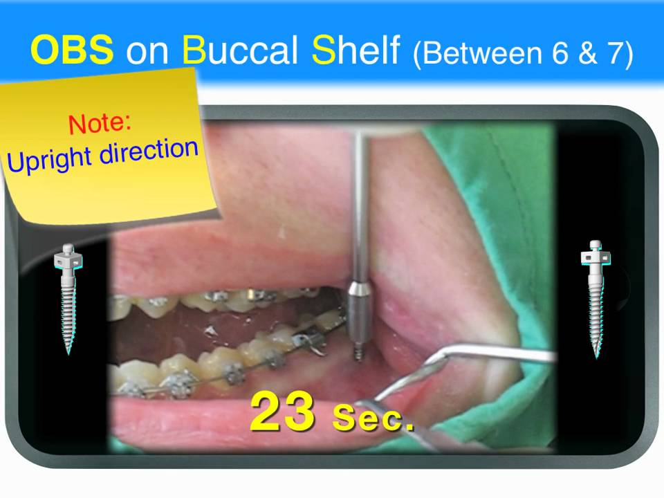 Impacted tooth L3