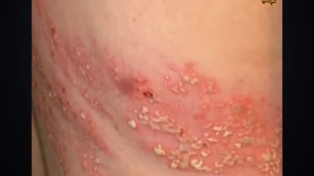 الحزام الناري الاعراض والمضاعفات