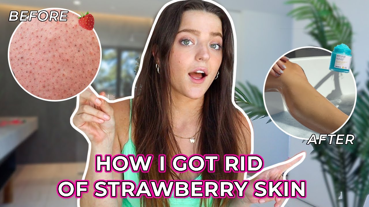 The TRUTH About How I Got Rid of My Strawberry Skin Truly Beauty!