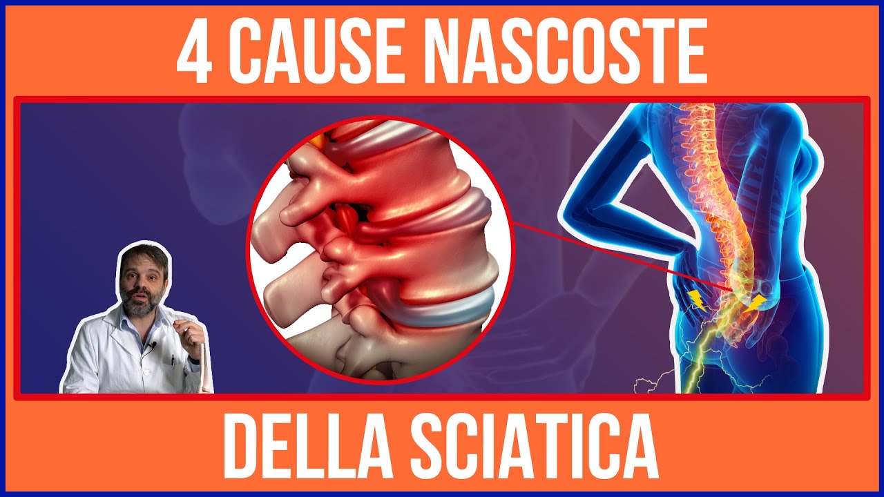 Ti SVELO il SEGRETO sulle 4 CAUSE della SCIATICA