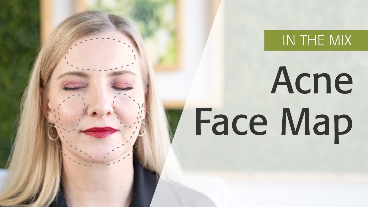 Acne Face Map | Eminence Organics