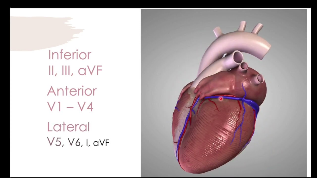 STEMI EKGs