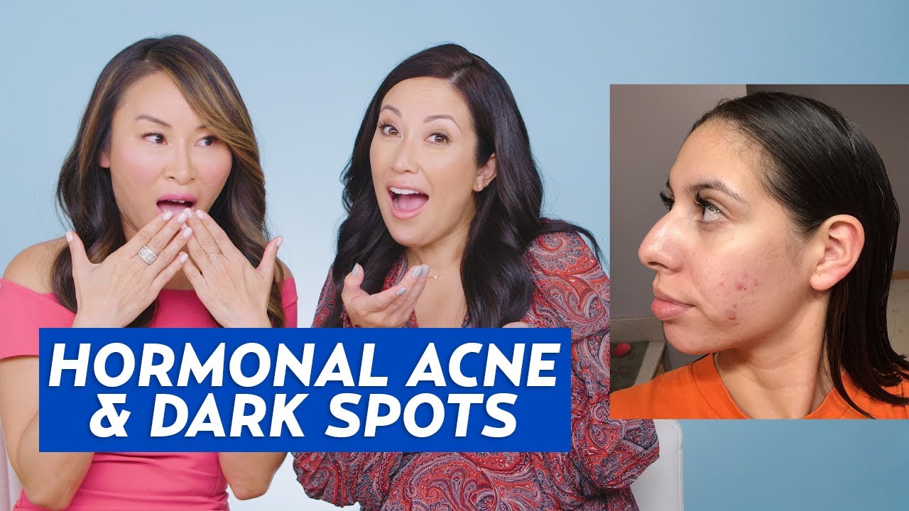 Hormonal Acne and Hyperpigmentation Skincare Routine for Giselle!