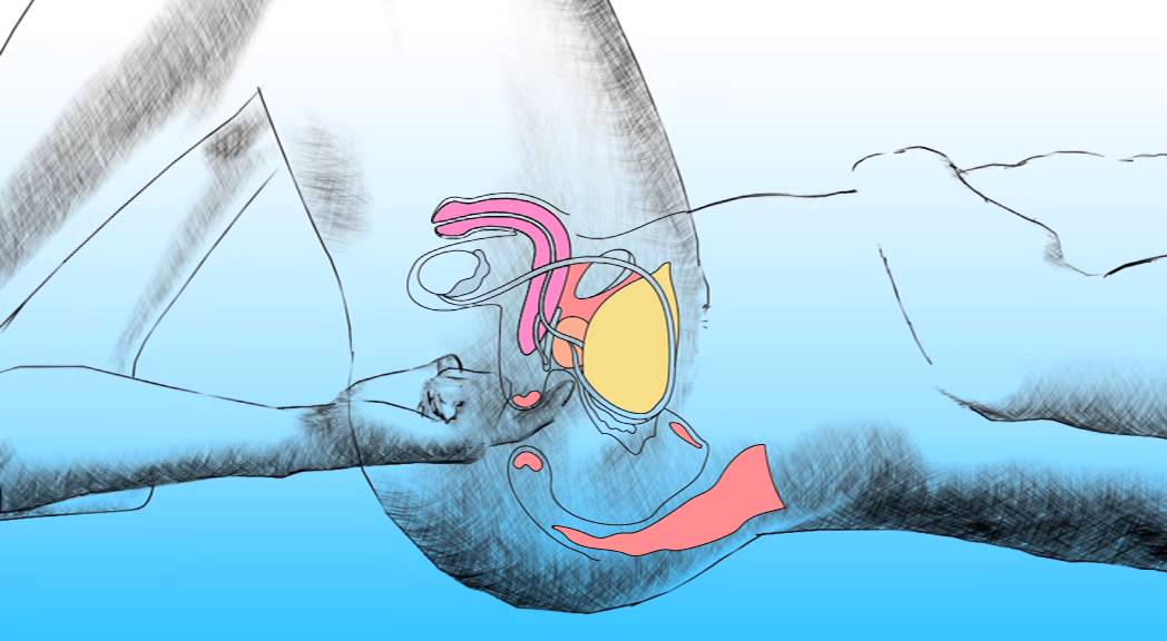 Echografie van de prostaat