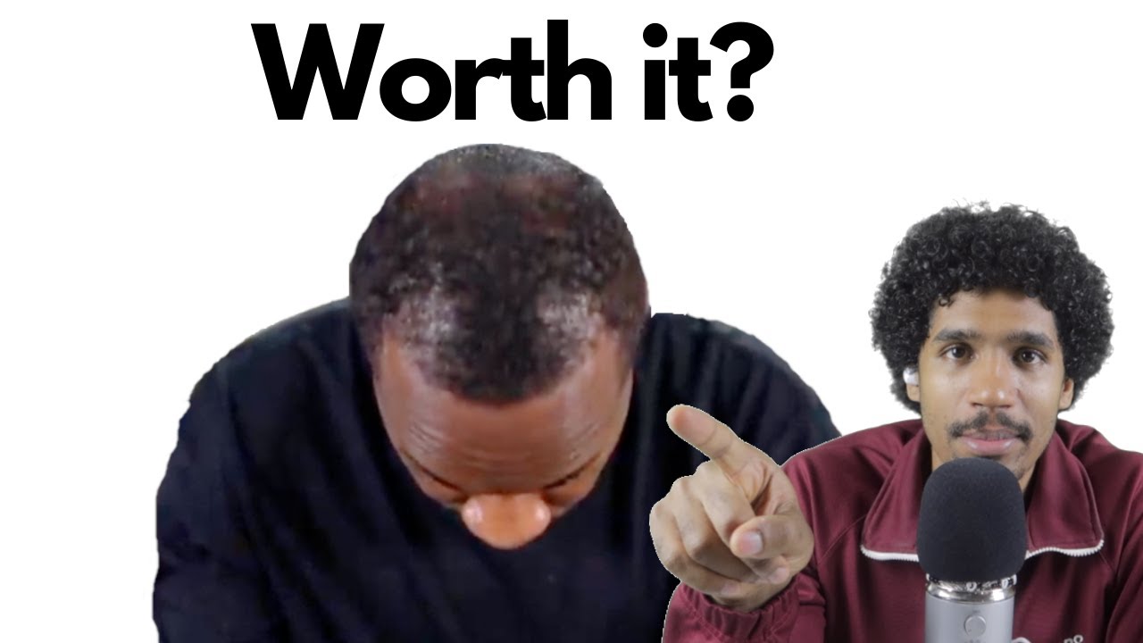 $6000 Afro Hair Transplant in USA | Barber Reacts