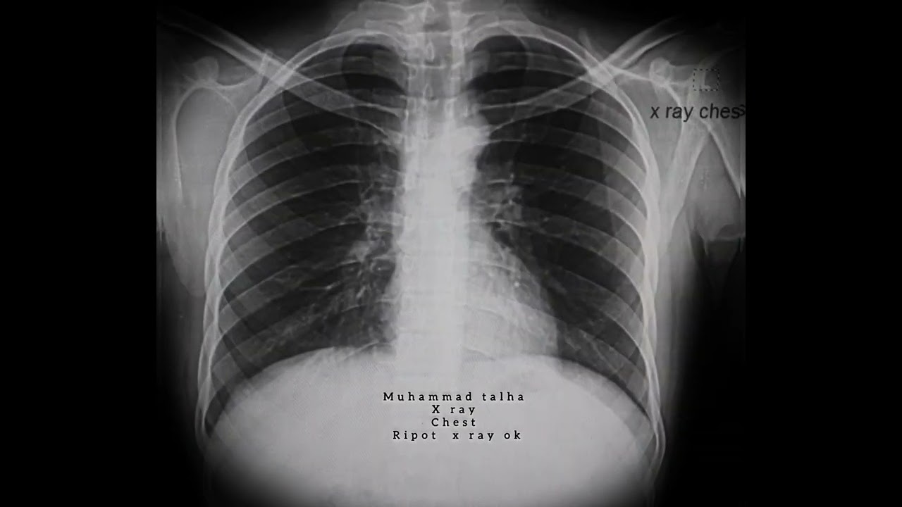 x ray position vidos, x ray chest position ap