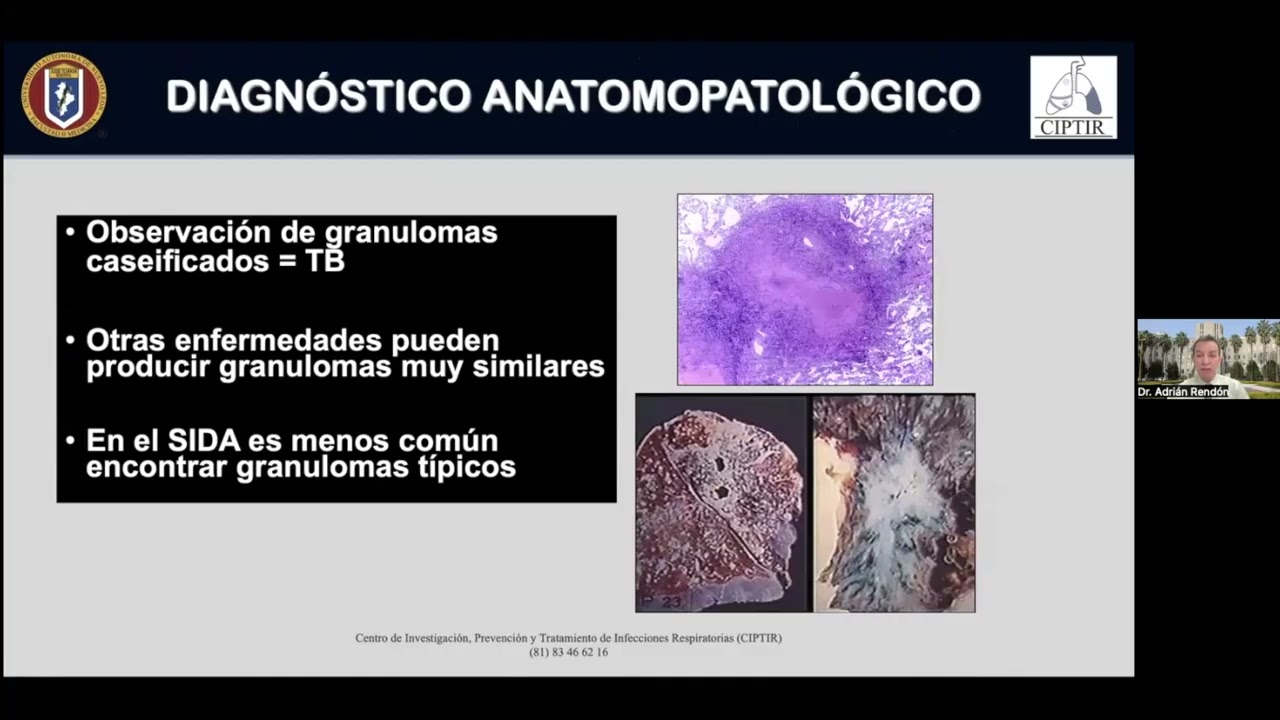 Dr. med. Luis Adri&aacute;n Rend&oacute;n P&eacute;rez - Algoritmos diagn&oacute;sticos para TB
