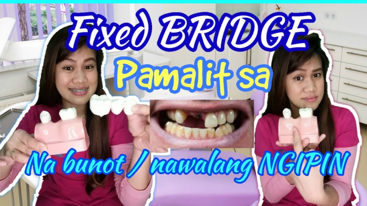 Zirconia Fixed Dental BRIDGE pamalit sa Nabunot na ngipin / magkano? Paano?