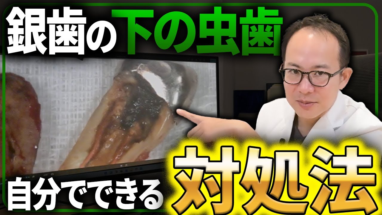 銀歯の裏側の虫歯は気づかないうちにヤバいことになってるかも？歯医者が被せ物の下の虫歯が進行した末路やその対処法について解説させていただきます