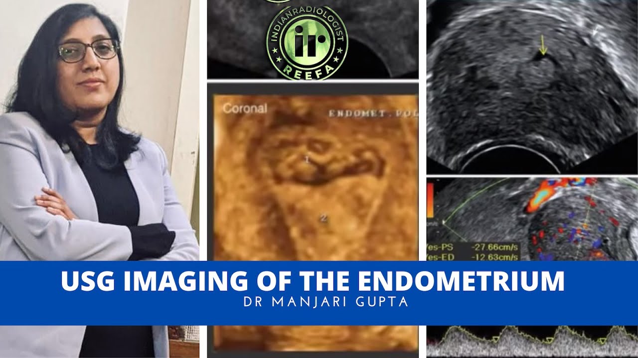 USG OF ENDOMETRIUM | DR MANJARI GUPTA | TVS SCAN PELVIS | SONOBUZZ PRELUDE ENDOMETRIAL POLYP | CA
