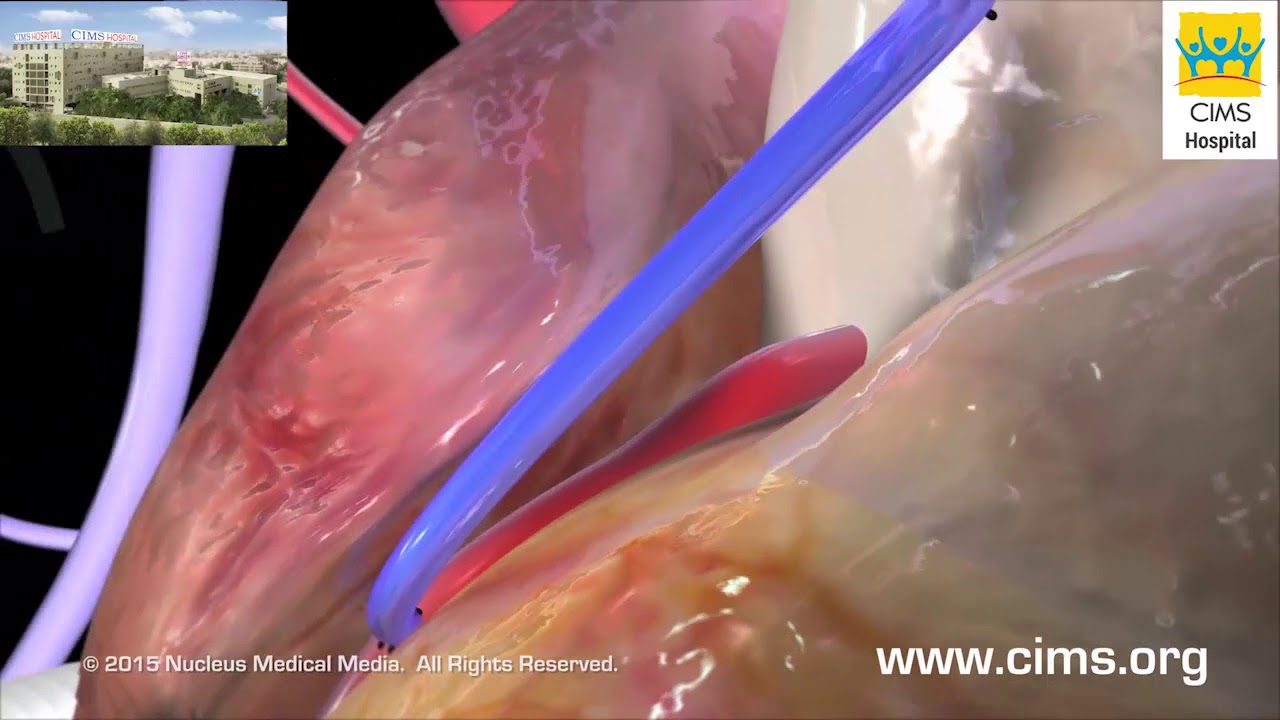 CABG (Hindi) - Dr.Dhiren Shah