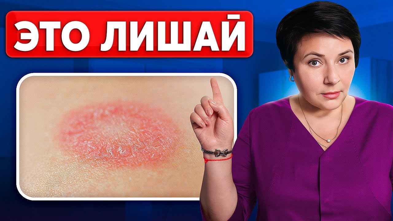 Как избавиться от лишая на коже? Пошаговая инструкция