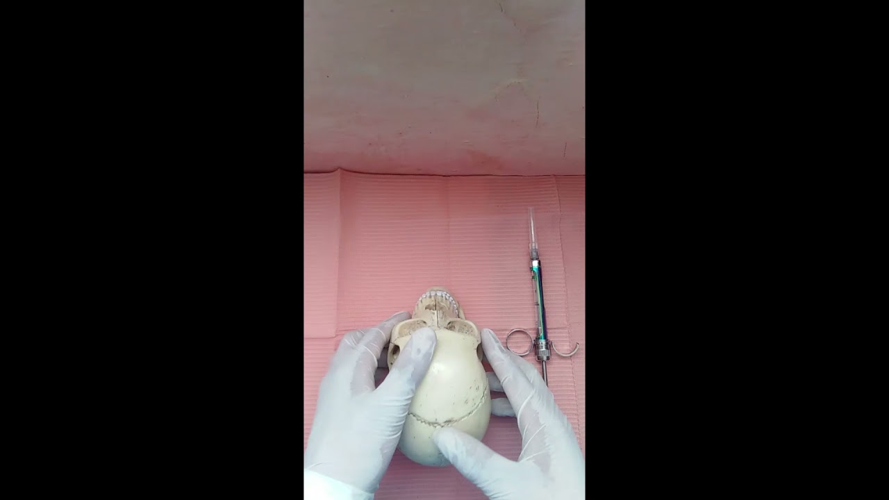 Anestesia Local de Nervios Incisivo y Mentoniano