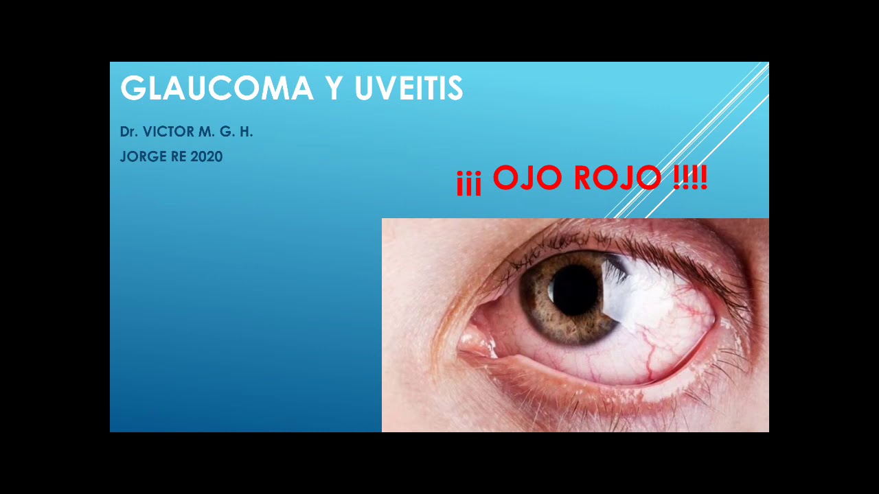 GLAUCOMA Y UVEITIS: OJO ROJO !