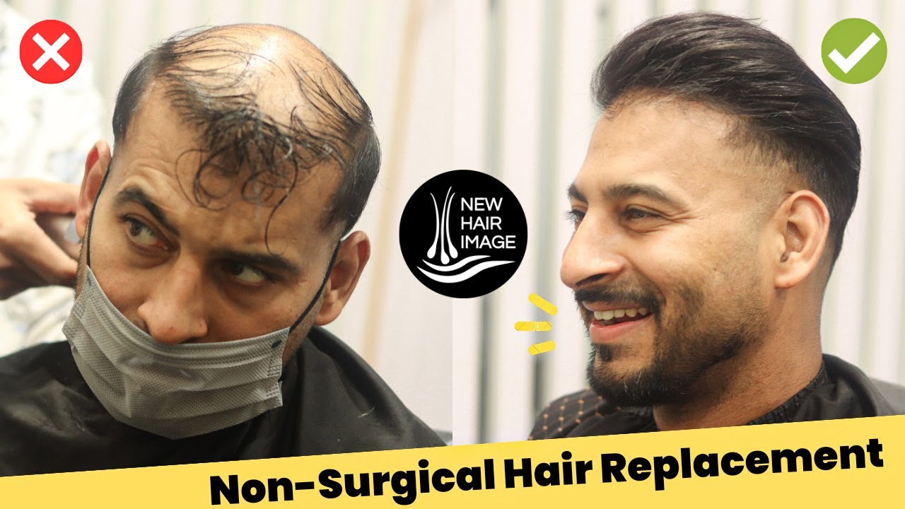 Non Surgical hair Replacement | Best Ever Hair Patch Transformation