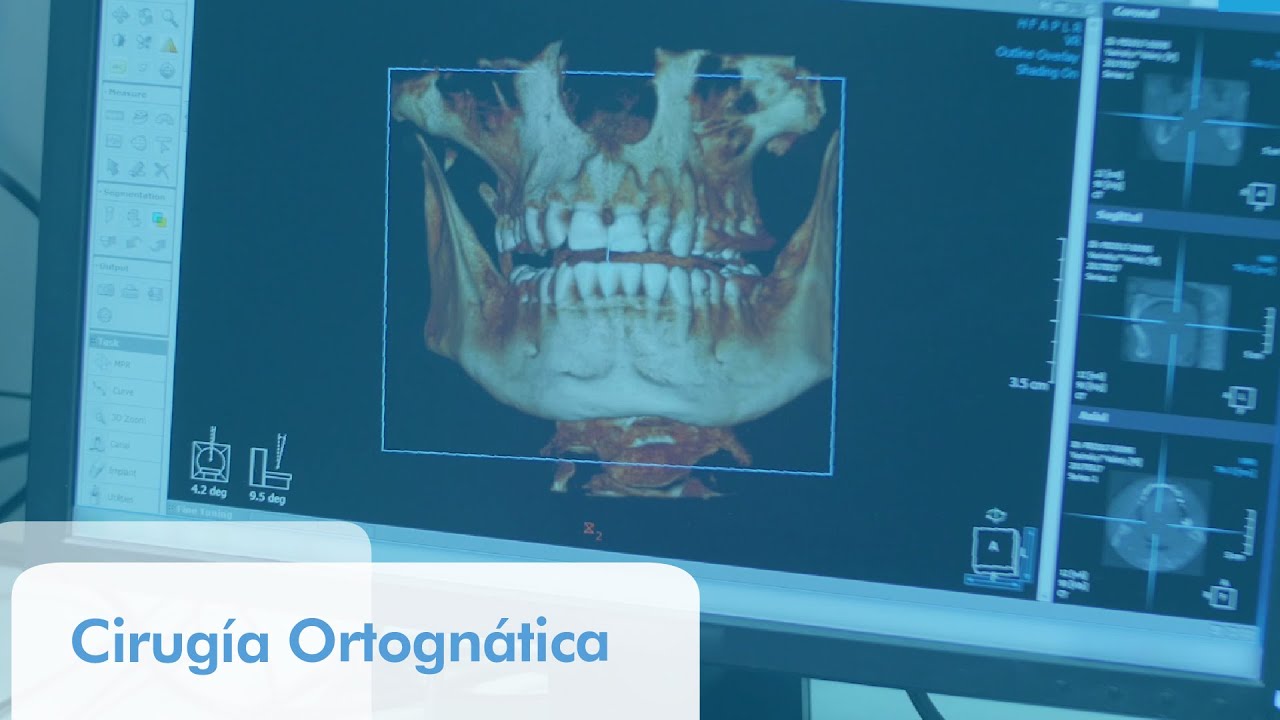 Cirugía Ortognática: corrección de huesos maxilares