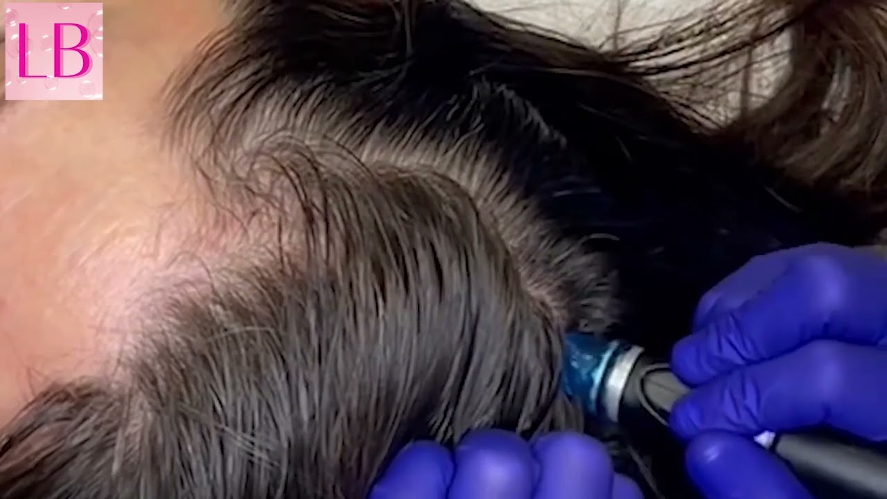 How to Have Great Hair with HydraFacial Keravive Treatment   New Scalp & Hair Treatment