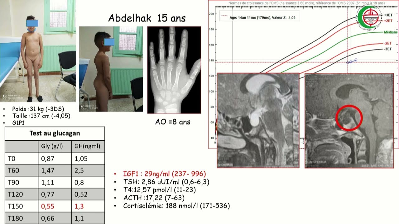 Pr NOUMI MUSTAPHA : Déficit en GH chez l'enfant